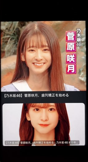 菅原咲月さんの裏側ワイヤー矯正の真相