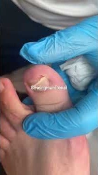 This Ingrown Toenail Needed Care! | Close-Up Removal