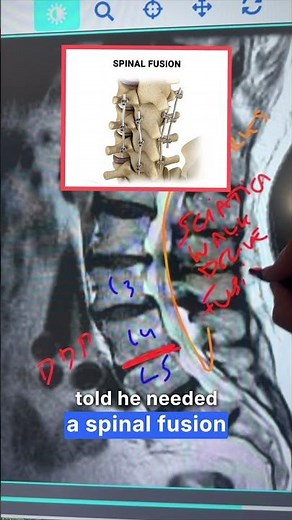 How spinal decompression helped Tom avoid surgery and relieve sciatica pain #SciaticaRelief