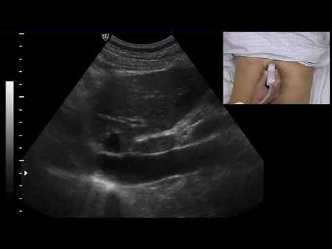IVC collapse combined