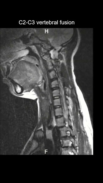 C2-C3 vertebral fusion with Scoliosis Sagittal Coronal T2 #MRI #Radiology #Shorts