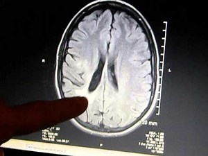 Multiple Sclerosis-MRI Lesion-Breea's Story