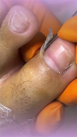 Did you know that pain next to your toenail isn't always caused by an ingrown nail?