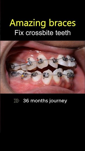 BRACES FOR CROSSBITE: FULL PROCESS REVEALED (Before & after) #braces #orthodontist #dentist