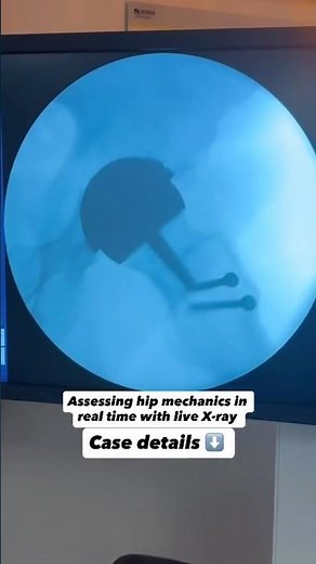 Hip Resurfacing Hip Flexor Pain After Surgery