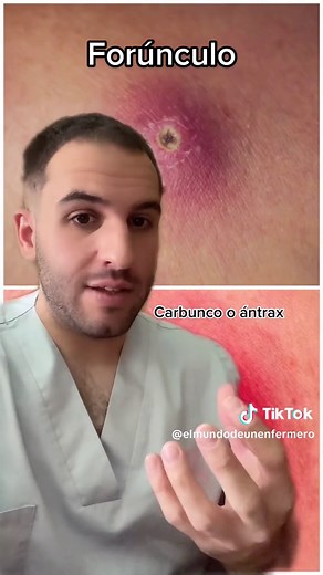 Lesiones en la piel por agentes infecciosos. En estos casos como tratamiento podemos aplicar medidas locales como compresas calientes para favorecer el drenaje espontáneo, drenaje quirúrgico, si no drena espontáneamente y un tratamiento con antibióticos #elmundodeunenfermero #enfermero #estudiantedeenfermeria #estudiantedemedicina #medico #dermatologia #lesiones #piel #infecciones #greenscreen