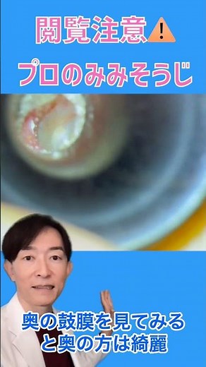 Earwax and ear canal eczema #earcleaning