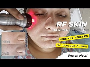 RadioFrequency Skin Tightening Treatments | Liposuction without Surgery | MY RF Experience