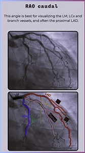 238K views · 1.1K reactions | A quick Guide to Standard Coronary Angiographic Views❣️ #Cardiology #Angiography #CathLab #MedicalEducation #CardioTwitter #HeartDisease #InterventionalCardiology Source: intuitivecardiology. notion. | Abdallah Othman | Facebook