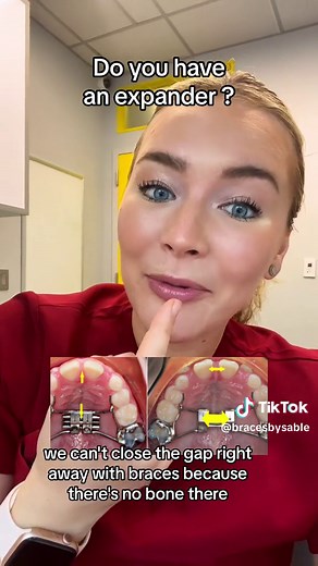 Replying to @hannah (Taylor’s version) if you have an expander this happens and don’t worry! We will get it closed as soon as possible! #expander #braces