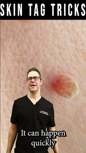 Skin Tag Removal & Plantar Wart Removal [Garlic, Iodine & Cider]