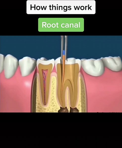 Denture Repairs Wimbledon: How Root Canal Surgery Works