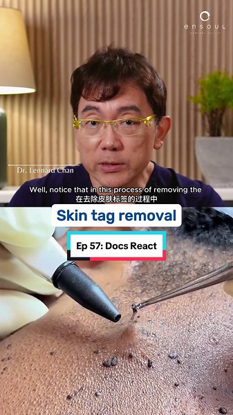 Skin tags, medically known as acrochordons, are small, soft, benign growths of skin that typically appear as small, flesh-coloured or slightly darker protrusions. They are most commonly found in areas where skin rubs against skin or clothing. But can these skin tags be removed? In this video, we find out. #tiktoksg #doctorsoftiktok #learningisfun #medicaltiktok #skintag #skintags #skintagremoval #laser #lasertreatment #drkenneththean #drkt #drchiam #drchiamchiakteng #drct #ensoul #ensoulmedicalc