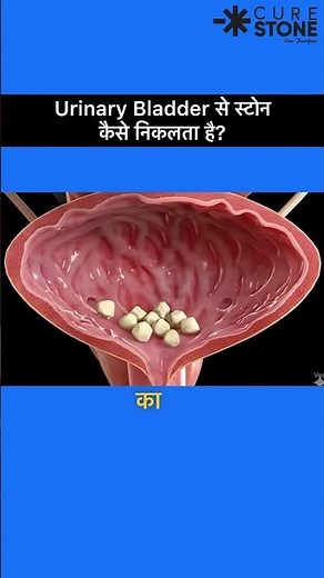 How stones comes out of the urinary bladder | how stones get removed easily