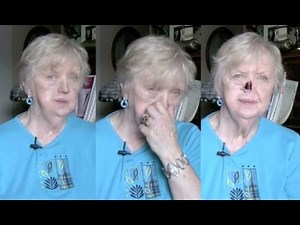 After losing her nose to cancer, Becky shares her story to help others