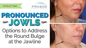 The Causes of  Jowl Fat and Treatment Options to Remove It