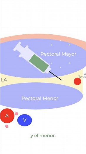 ¿Conoces las diferencias entre el PECS I y el PECS II?