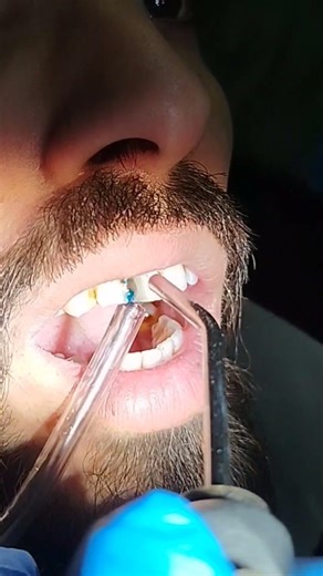 total etch technique #dentist #shorts