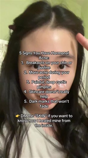 Understanding Hormonal Acne: 5 Key Signs to Identify
