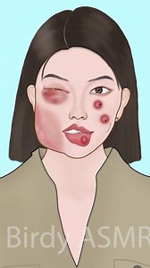 ASMR treatment for bee sting swollen face animation P1 #asmr #animation #asmranimation #satisfying #trending | Birdy ASMR