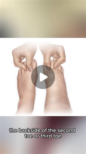 Dr. Boris Volshteyn on Instagram: "The Stemmer test is a quick way to determine if someone might have lymphedema or lipedema. Here’s how it works: Find the second toe (not the big one) and pinch the backside of the second or third toe. If you can’t pinch it, it’s likely NOT lymphedema (Negative Test). If you CAN pinch it, it indicates lymphedema (Positive Test). Note: For patients with both lipedema and lymphedema, known as lipo-lymphedema, the test might still be positive due to the combination