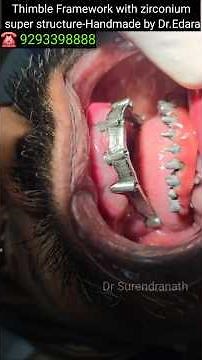 Thimble framework on all on 6 implants by Dr Edara Surendranath #drsurendranath #dentistry #implant