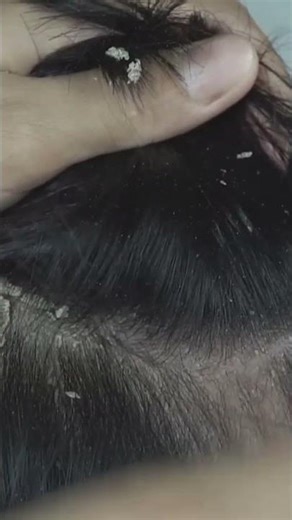 Quick and Easy Removing Scratching Big Dandruff Flakes