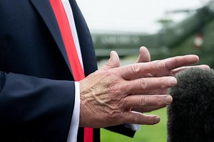 What we know about Trump's bruised hand and health condition