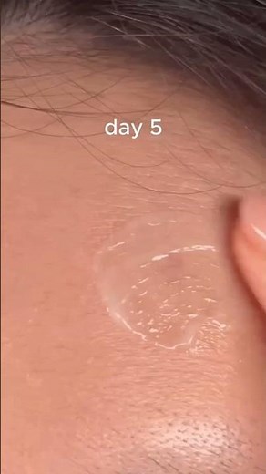 Erytop gel #pimple #acnetreatment #acneproneskincareroutine