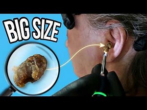 Severely Impacted Ear Wax Removed Safely | Big Size Reveal #earwaxremoval #earwax #hugeearwaxremoval
