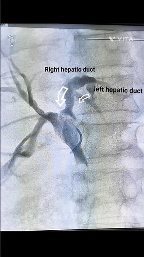 PTBD Stenting (Percutaneous Transhepatic Biliary Drainage with Stent)- #PTBDStenting#Drainage#Liver