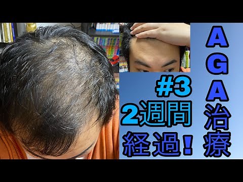 AGA治療2週間経過！皮脂の過剰分泌の抑制と初期脱毛ジュニア！？