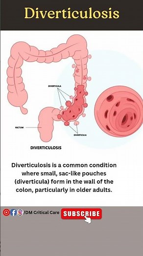 Diverticulosis|Sac-like pouches(diverticula) form in Colon|Colon Disease #diverticulosis #ytshorts