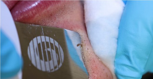 Extractions with the bt-micro fusion