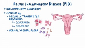 Video: Pelvic inflammatory disease: Clinical sciences - Video Explanation! | Osmosis | Osmosis