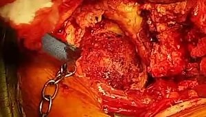 Cemented Cup, Surgical Technique