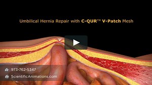 Inguinal Hernia Mesh - 3D Medical Animation