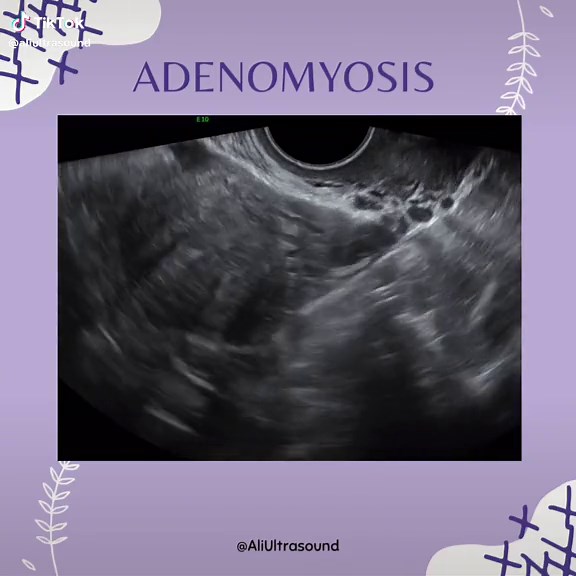 Adenomyosis Diagnosis with Ultrasound Techniques