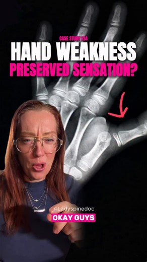 Case Study 214 – Finger Weakness A 38-year-old woman presents with a strange new problem…She suddenly can’t extend her fingers. But she can extend her wrist. No pain. No trauma. One big change? She recently started an upper-body workout routine…and it’s brand new for her. 👀 So what’s going on? ➡️ What’s the most likely diagnosis? ➡️ Where is the lesion localized? ➡️ And what’s the right treatment? Drop your thoughts below ⬇️. Let’s see who gets it right. 📌 Stay tuned tomorrow — I’ll break down