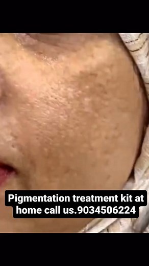 4.4K views · 5 comments | Call us.9034506224 for order online your personal pigmentation treatment kit at home @nisha_lambha @nisha_lambha_official_ @khaliyat_ #trendingreels #trend #treatment #trending #tbt #video #viral #explore #explorepage #reels #reelsinstagram #instagram #instagood #facetreatment | Nisha Lambha - Sparsh Beauty Care & Hair Treatment LLP 5 | Facebook