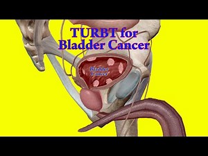 TURBT - How to do Transurethral Resection of Bladder Tumor - Bladder Cancer Surgery