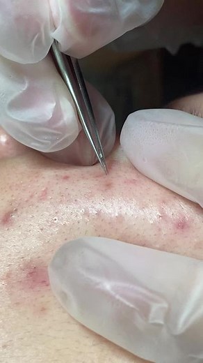 Pore Extraction Techniques for Healthy Skin