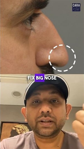 Can Non Surgical Rhinoplasty Fix Big Tip Of The Nose | Explained By Dr. Asif