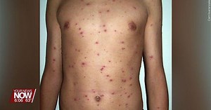 Health officials report clusters of chickenpox outbreaks around Ohio
