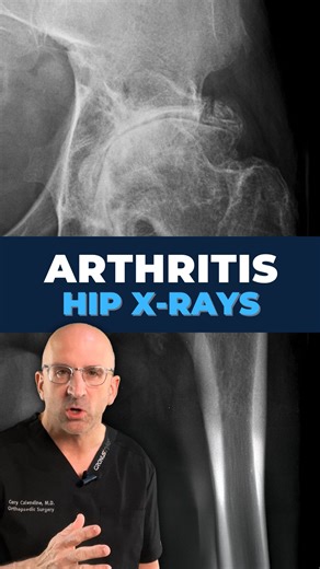 Cory Calendine MD on Instagram: "Hip Osteoarthritis Progression in X-ray Imaging . Hip radiographs serve as critical diagnostic tools that reveal structural changes occurring within the joint over time, providing objective evidence of disease severity/progression. When evaluating #hiposteoarthritis: 🔹Joint Space Narrowing: one of the most significant indicators, reflecting the gradual loss of protective cartilage between the femoral head - acetabulum. This narrowing can be measured at the narro