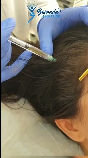 L’injection de PRP permet d’améliorer la qualité des cheveux et de la peau du visage