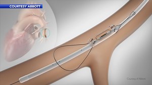 CardioMEMS device aims to keep heart failure patients out of the hospital