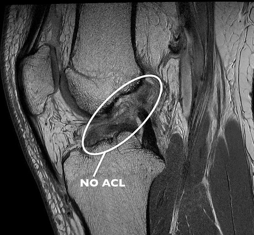 Basic MRI Evaluation of an ACL Tear
