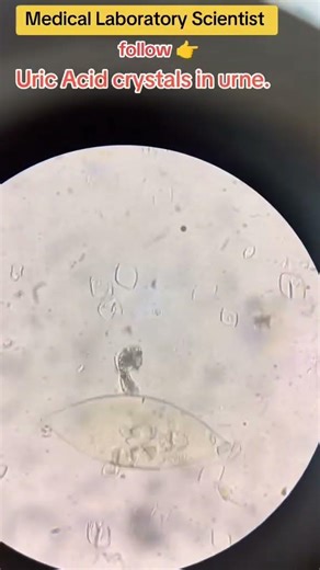 uric acid crystals in urine.#urine #microbiology #hematology #medicalbiochemistry #parasitology