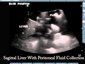Paracentesis Ultrasound Training Model